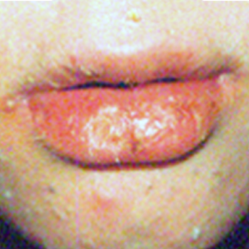 Accutane Lips before Dr. Dan's treatment