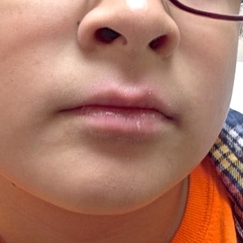 boy's lips after psoriasis treatment