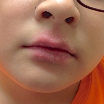 boy with psoriasis on lips