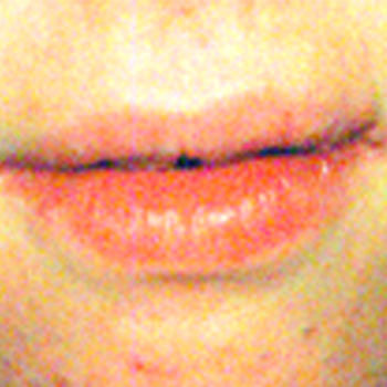 Accutane Lips after Dr. Dan's treatment