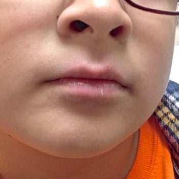 boy's lips after psoriasis treatment